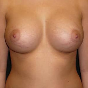Case #5167 – Breast Augmentation