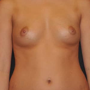 Case #5167 – Breast Augmentation