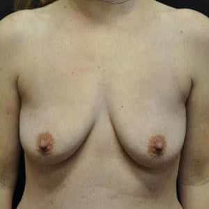Case #5155 – Breast Augmentation