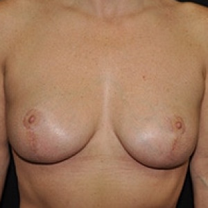 After Image: Case #3441 – Breast Lift - front