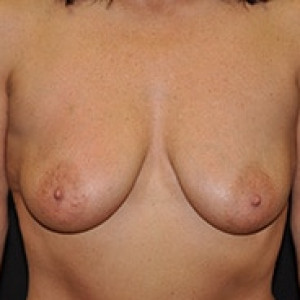 Before Image: Case #3441 – Breast Lift - front