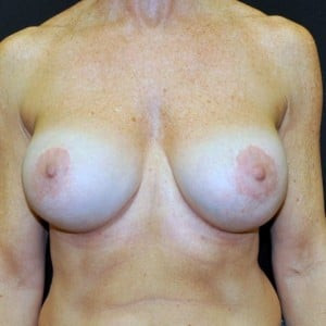 After Image: Case #3727 – Breast Revision/Correction - front