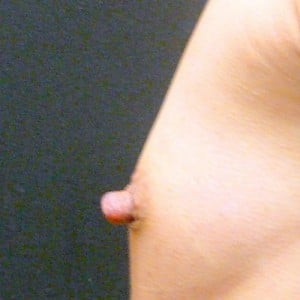 Case #2454 – Nipple Reduction