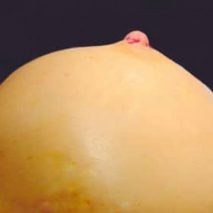 After Image: Case #2449 – Nipple Reduction - front