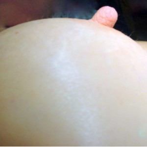 Before Image: Case #2449 – Nipple Reduction - front