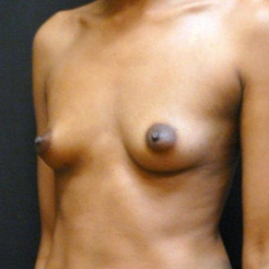Case #3714 – Ethnic Breast Surgery
