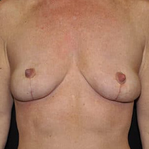 Case #5121 – Breast Lift with Breast Augmentation