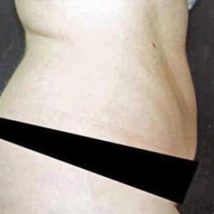 After Image: Case #2585 – Tummy Tuck - other