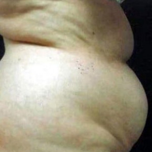 Before Image: Case #2585 – Tummy Tuck - other