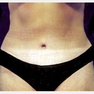 After Image: Case #2582 – Tummy Tuck - front
