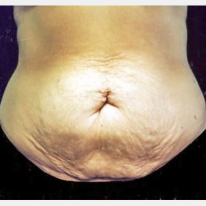 Before Image: Case #2582 – Tummy Tuck - front