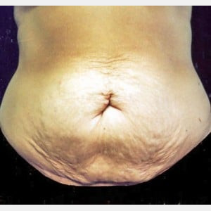 Case #2582 – Tummy Tuck