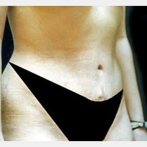 After Image: Case #2571 – Tummy Tuck - right-front-oblique