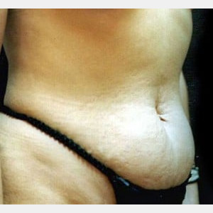 Before Image: Case #2571 – Tummy Tuck - right-front-oblique