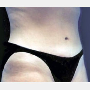 After Image: Case #2565 – Tummy Tuck - right-front-oblique
