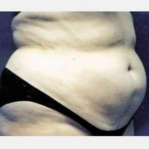 Before Image: Case #2565 – Tummy Tuck - right-front-oblique