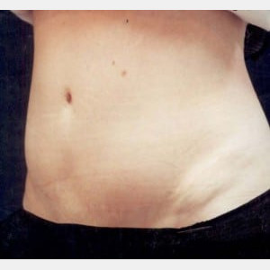 After Image: Case #2560 – Tummy Tuck - left-front-oblique