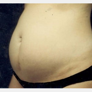 Before Image: Case #2560 – Tummy Tuck - left-front-oblique