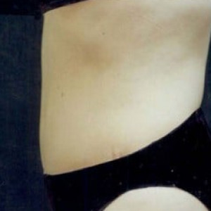 After Image: Case #2560 – Tummy Tuck - other