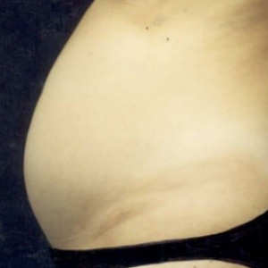 Before Image: Case #2560 – Tummy Tuck - other
