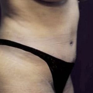 After Image: Case #2552 – Tummy Tuck - right-front-oblique