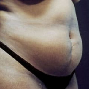 Before Image: Case #2552 – Tummy Tuck - right-front-oblique