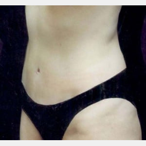 After Image: Case #2555 – Tummy Tuck - left-front-oblique
