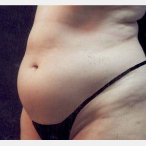 Before Image: Case #2555 – Tummy Tuck - left-front-oblique