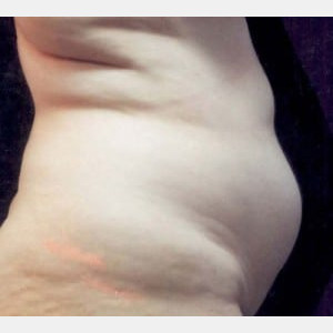 Before Image: Case #2555 – Tummy Tuck - other