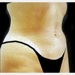 After Image: Case #2546 – Tummy Tuck - right-front-oblique