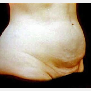 Before Image: Case #2546 – Tummy Tuck - right-front-oblique
