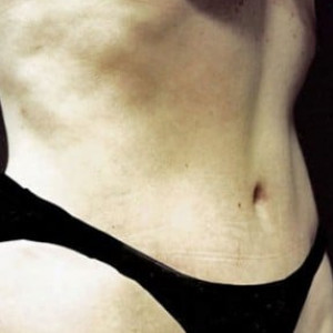 After Image: Case #2543 – Tummy Tuck - right-front-oblique