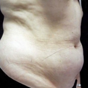 Before Image: Case #2543 – Tummy Tuck - right-front-oblique