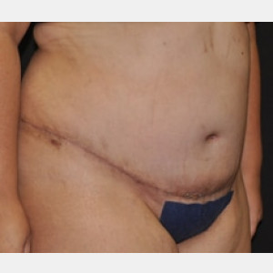 After Image: Case #4150 – Tummy Tuck - right-front-oblique