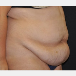 Case #4150 – Tummy Tuck