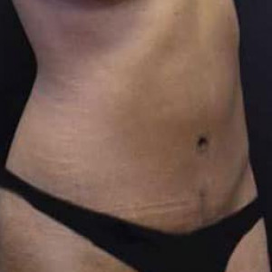 After Image: Case #2540 – Tummy Tuck - right-front-oblique