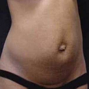 Before Image: Case #2540 – Tummy Tuck - right-front-oblique
