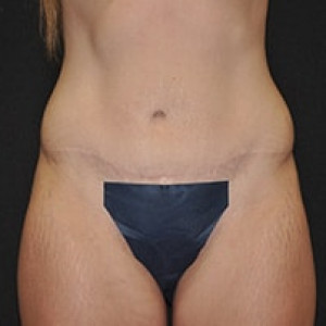 After Image: Case #3971 – Tummy Tuck - front