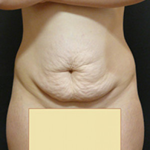 Before Image: Case #3971 – Tummy Tuck - front
