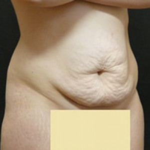 Before Image: Case #3971 – Tummy Tuck - right-front-oblique