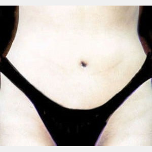 After Image: Case #2577 – Tummy Tuck - front
