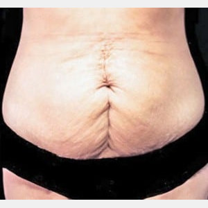 Before Image: Case #2577 – Tummy Tuck - front