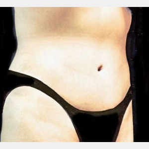 After Image: Case #2577 – Tummy Tuck - right-front-oblique