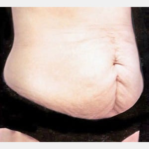 Before Image: Case #2577 – Tummy Tuck - right-front-oblique