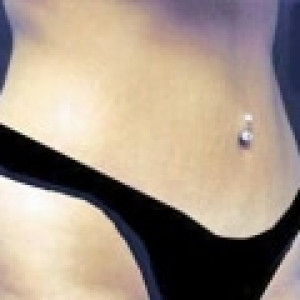 After Image: Case #2537 – Tummy Tuck - right-front-oblique