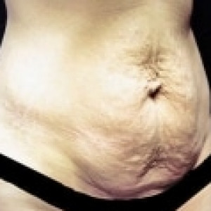 Before Image: Case #2537 – Tummy Tuck - right-front-oblique