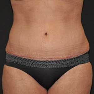 After Image: Case #3912 – Tummy Tuck - front