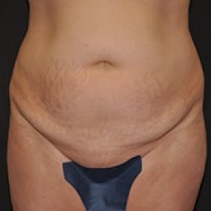 Before Image: Case #3912 – Tummy Tuck - front