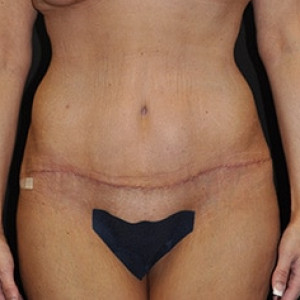 After Image: Case #3933 – Tummy Tuck - front