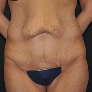 Before Image: Case #3933 – Tummy Tuck - front
